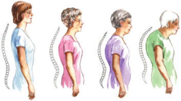 Why Having A Good Posture Is Essential As You Age